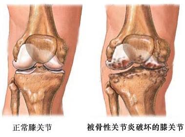 膝骨關節(jié)炎.jpg