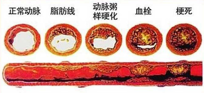 血栓在哪，病就在哪！該怎么清除血栓呢？
