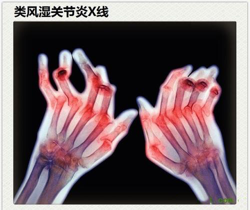 類風(fēng)濕性關(guān)節(jié)炎真的是“不死的癌癥”？