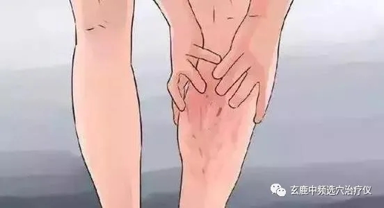 治療靜脈曲張，中醫(yī)有良方，一根針讓你告別“蚯蚓”腿