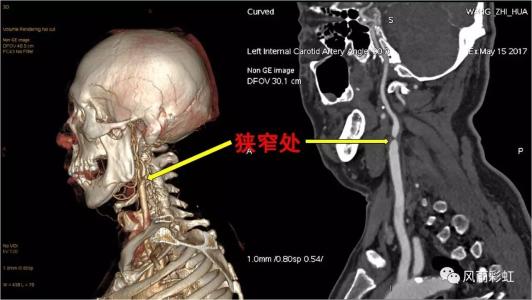 頸椎病都是“積”出來(lái)的，4個(gè)傷頸的行為，別總是做